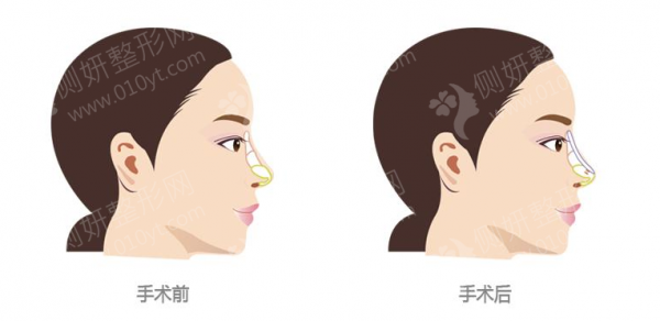 山东鼻子整形好的医院排名