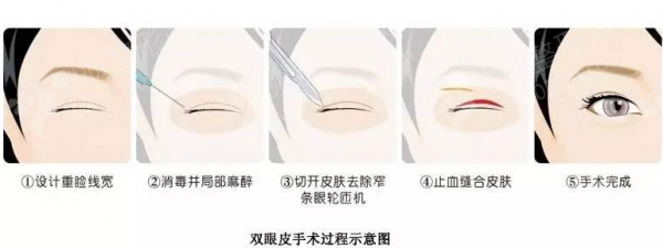青医附院整形科双眼皮医生
