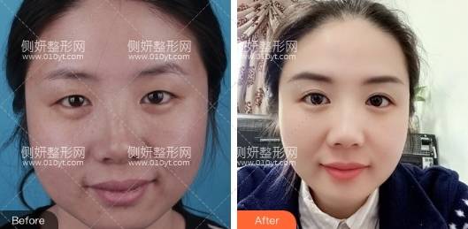 华西医院美容科祛眼袋多少钱