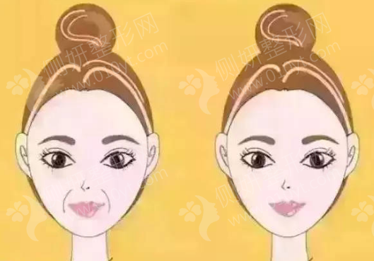 青海红十字医院整形美容科脂肪填充脸部