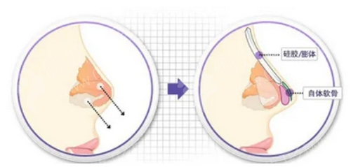 深圳北大医院肋软骨隆鼻