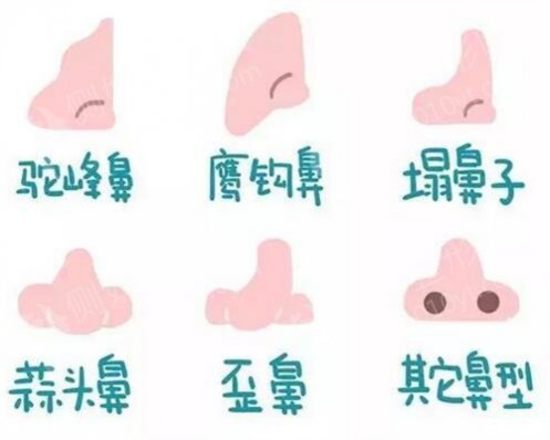珠海市中西医结合医院整形美容外科肋软骨隆鼻