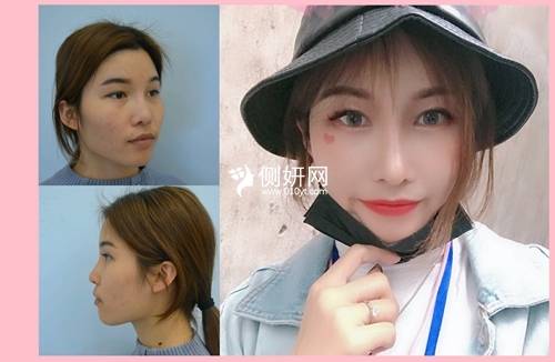 北京301医院下巴抽脂