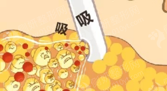 湘雅二医院抽脂减肥