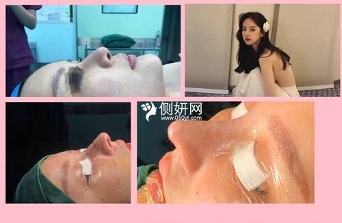 章丘市人民医院整形科肋软骨隆鼻