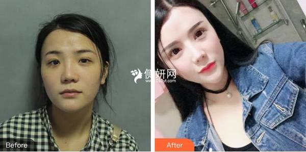 西宁市第一人民医院整形美容科假体隆鼻