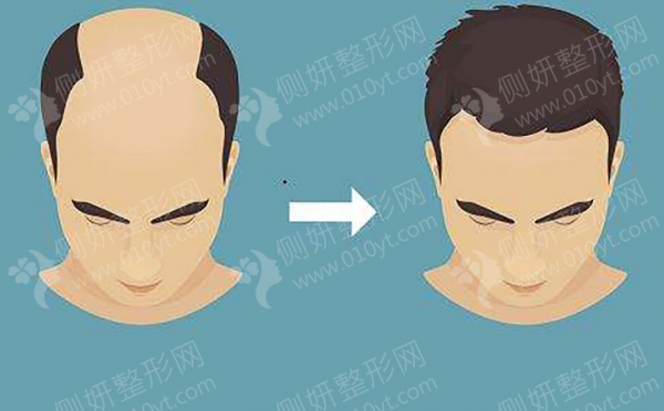 长沙新生植发医院发际线种植