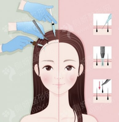 宁波市第二医院整形美容外科发际线植发