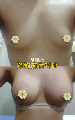 中日友好医院隆胸手术