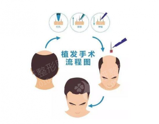 北京301医院植发