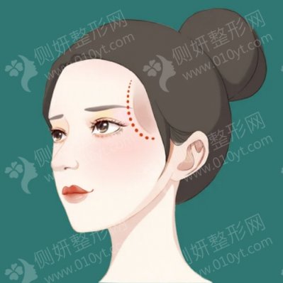 海南医学院附属医院整形科假体隆鼻