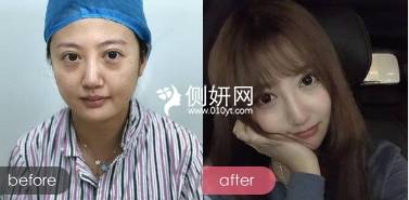沙井人民医院整形科全切双眼皮