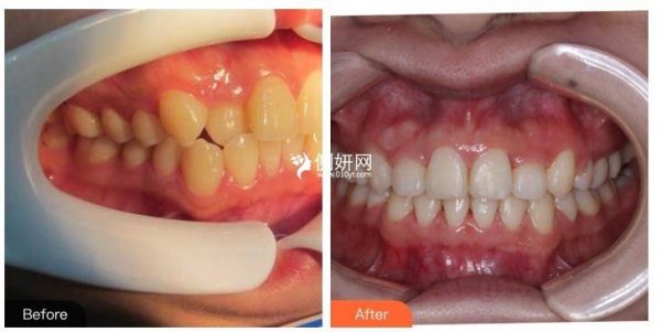 中山香山口腔医院牙齿种植