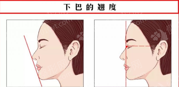 深圳北大医院双下巴吸脂