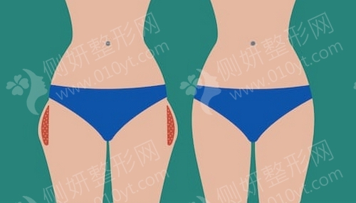北医三院吸脂手术