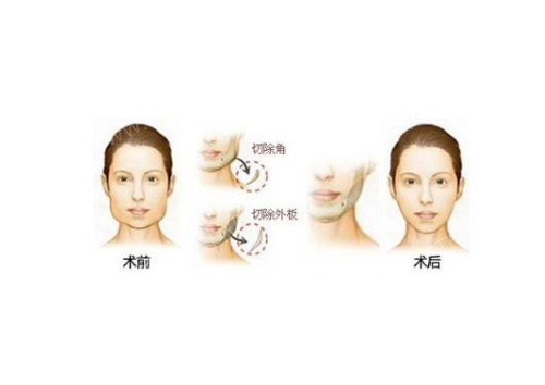 西安磨骨整形医院