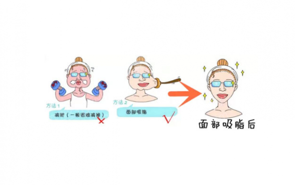 西京医院脸部吸脂