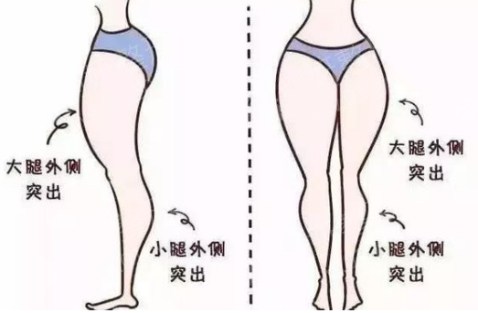 北京同仁医院大腿吸脂