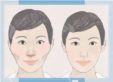 西京医院磨骨手术