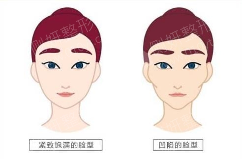 西安自体脂肪填充整形医院自体脂肪填充面部
