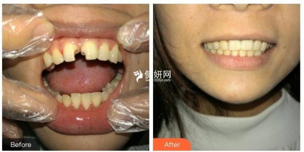 汉中三二Ｏ一医院口腔科牙齿矫正