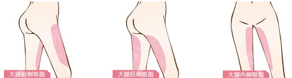 北京八大处小腿吸脂