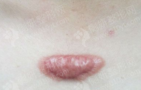 北京正美医疗美容疤痕修复