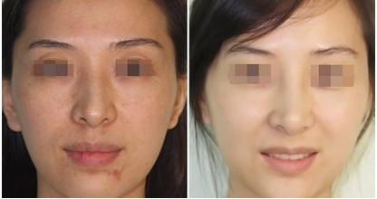 深圳美莱整形医院瘦脸针怎么做效果更好？